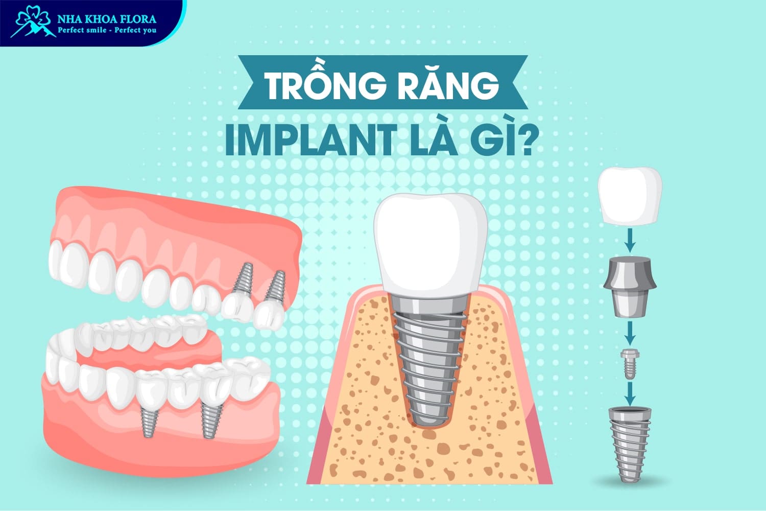 Trồng Răng Implant Là Gì? 10 Điều Cần Biết Trước Khi Thực Hiện - ảnh 1 Trồng Răng Implant Là Gì? 10 Điều Cần Biết Trước Khi Thực Hiện - ảnh 1