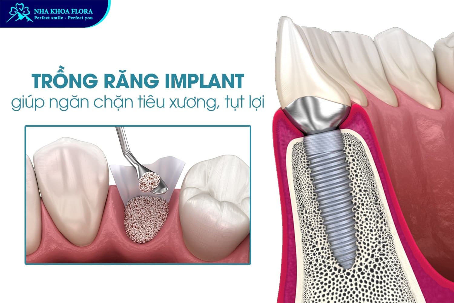 Trồng Răng Implant Là Gì? 10 Điều Cần Biết Trước Khi Thực Hiện - ảnh 3 Trồng Răng Implant Là Gì? 10 Điều Cần Biết Trước Khi Thực Hiện - ảnh 3