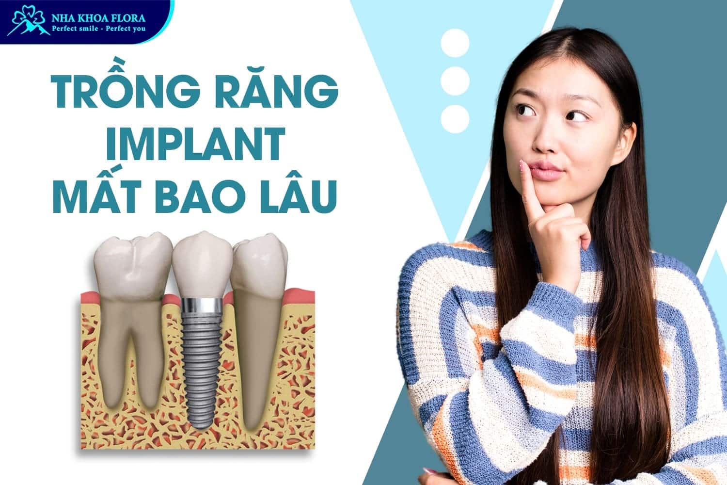 Trồng Răng Implant Là Gì? 10 Điều Cần Biết Trước Khi Thực Hiện - ảnh 4 Trồng Răng Implant Là Gì? 10 Điều Cần Biết Trước Khi Thực Hiện - ảnh 4