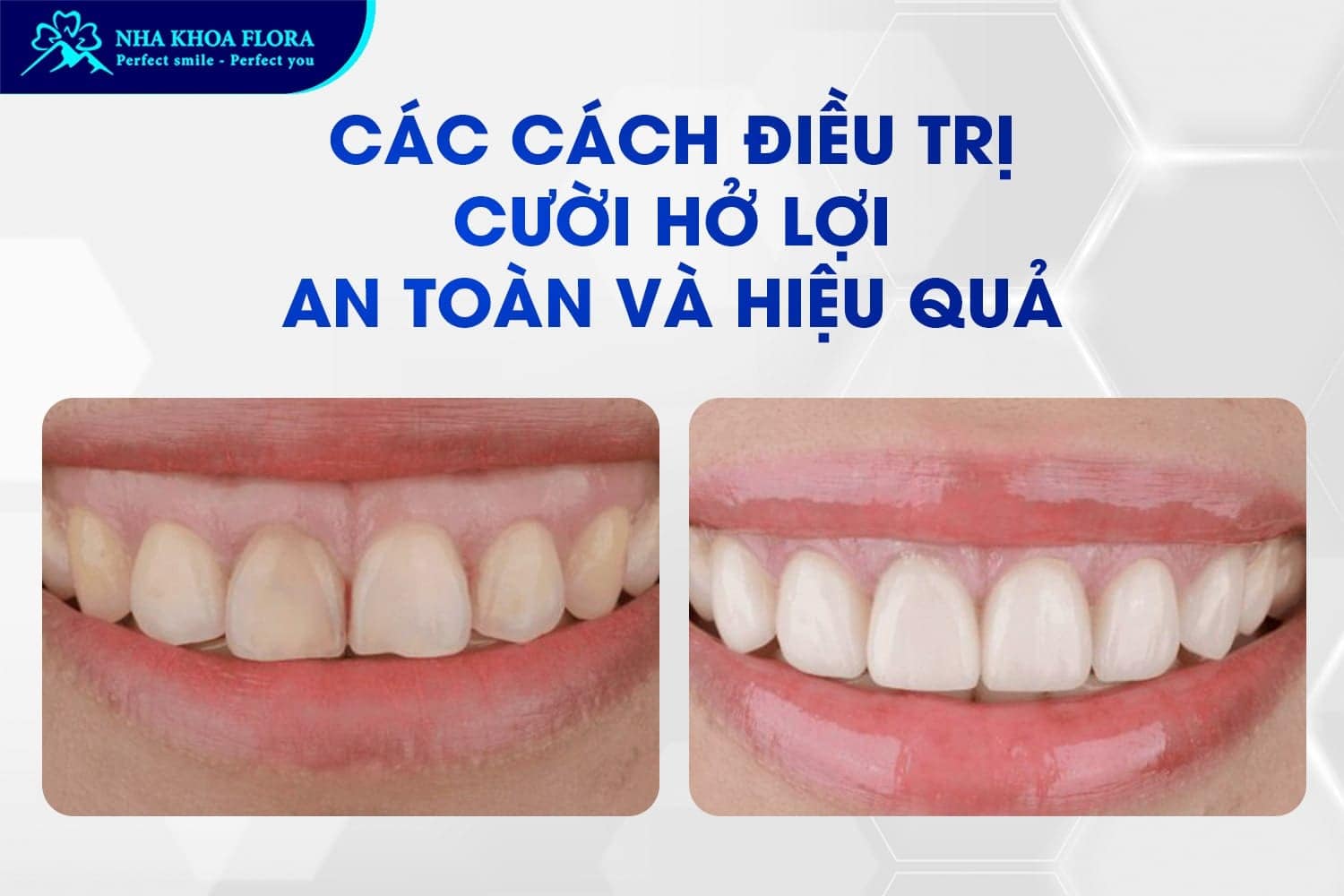 Con Gái Cười Hở Lợi Phải Làm Sao? Tướng Số Thế Nào? - ảnh 4 Con Gái Cười Hở Lợi Phải Làm Sao? Tướng Số Thế Nào? - ảnh 4