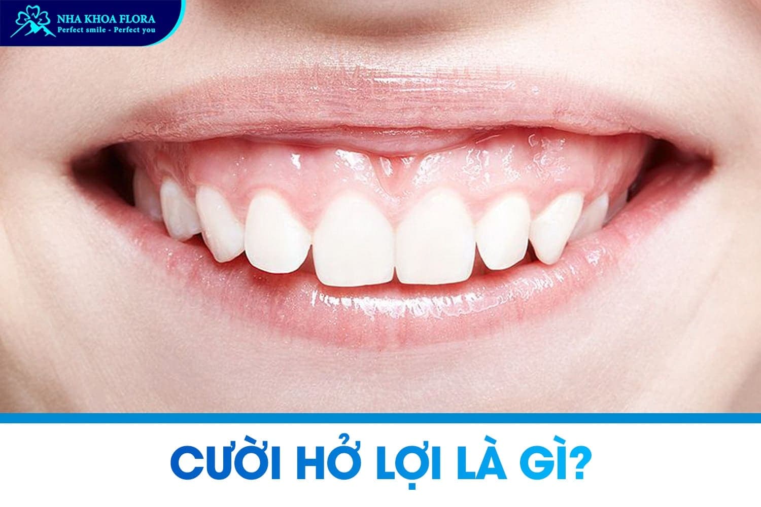 Cười Hở Lợi Là Gì? Nguyên Nhân Và Cách Khắc Phục Hiệu Quả - ảnh 1 Cười Hở Lợi Là Gì? Nguyên Nhân Và Cách Khắc Phục Hiệu Quả - ảnh 1