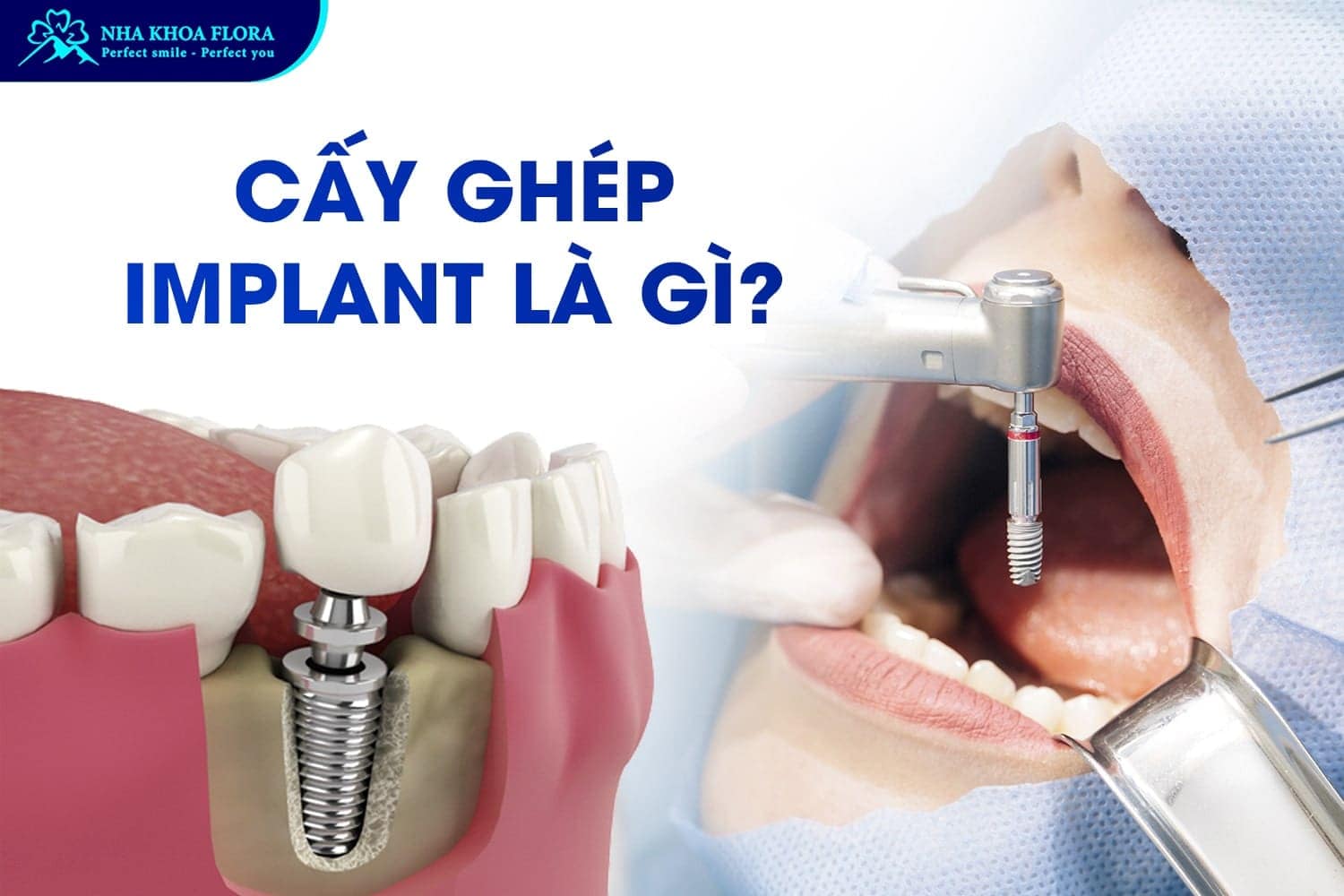 Giải Đáp Khi Nào Nên Trồng Răng Implant? - ảnh 1 Giải Đáp Khi Nào Nên Trồng Răng Implant? - ảnh 1