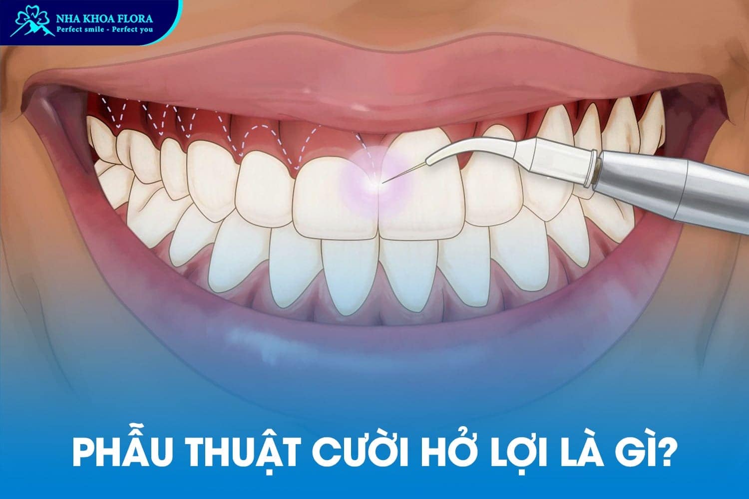 Phẫu Thuật Cười Hở Lợi Có Đau Không? Giá Bao Nhiêu? - ảnh 1 Phẫu Thuật Cười Hở Lợi Có Đau Không? Giá Bao Nhiêu? - ảnh 1