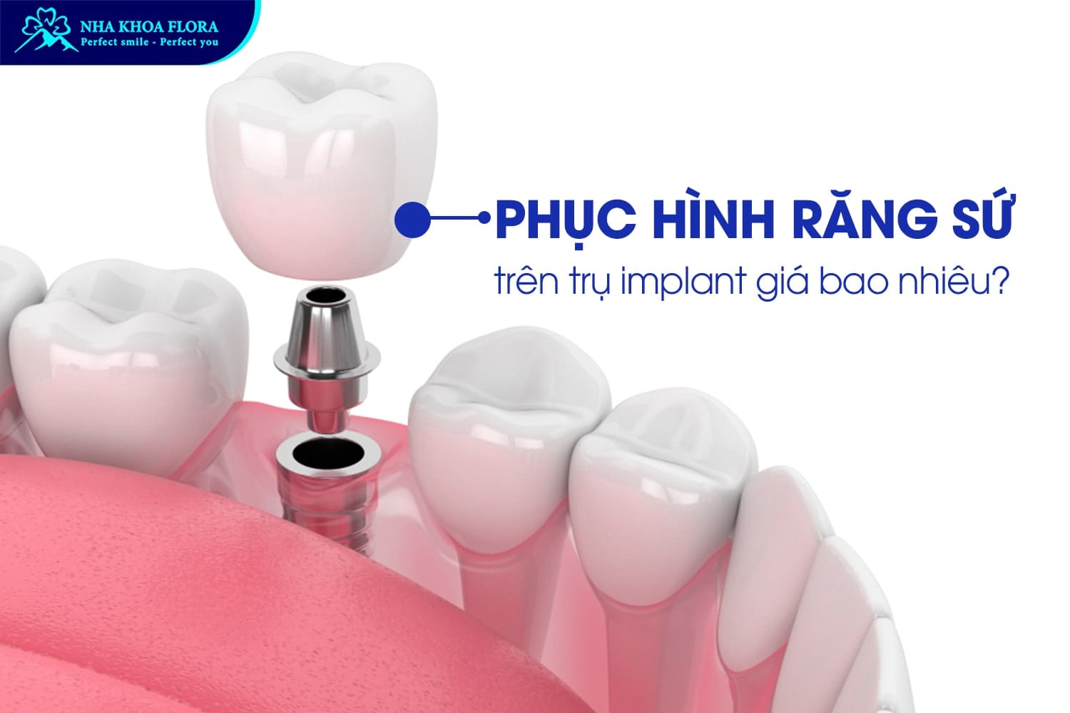 Trồng Răng Implant Giá Bao Nhiêu? - ảnh 4 Trồng Răng Implant Giá Bao Nhiêu? - ảnh 4