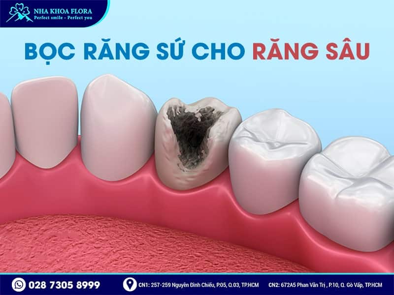 Khi nào nên bọc răng sứ - ảnh 2 Khi nào nên bọc răng sứ - ảnh 2