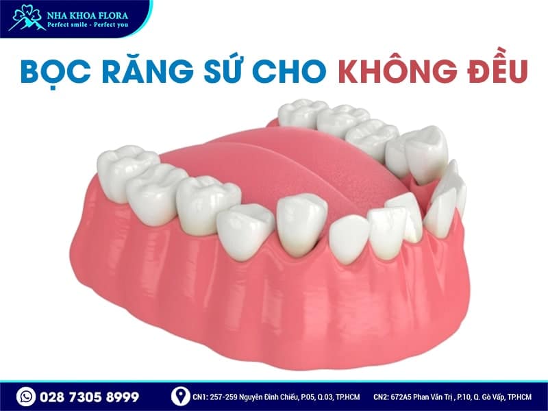Khi nào nên bọc răng sứ - ảnh 3 Khi nào nên bọc răng sứ - ảnh 3