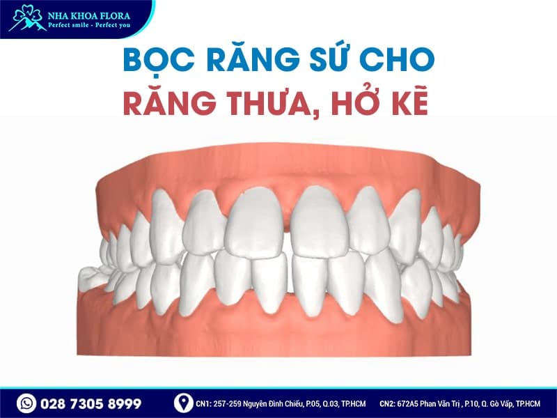 Khi nào nên bọc răng sứ - ảnh 4 Khi nào nên bọc răng sứ - ảnh 4