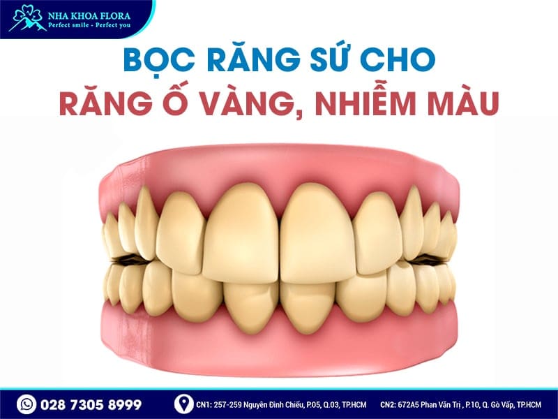 Khi nào nên bọc răng sứ - ảnh 5 Khi nào nên bọc răng sứ - ảnh 5