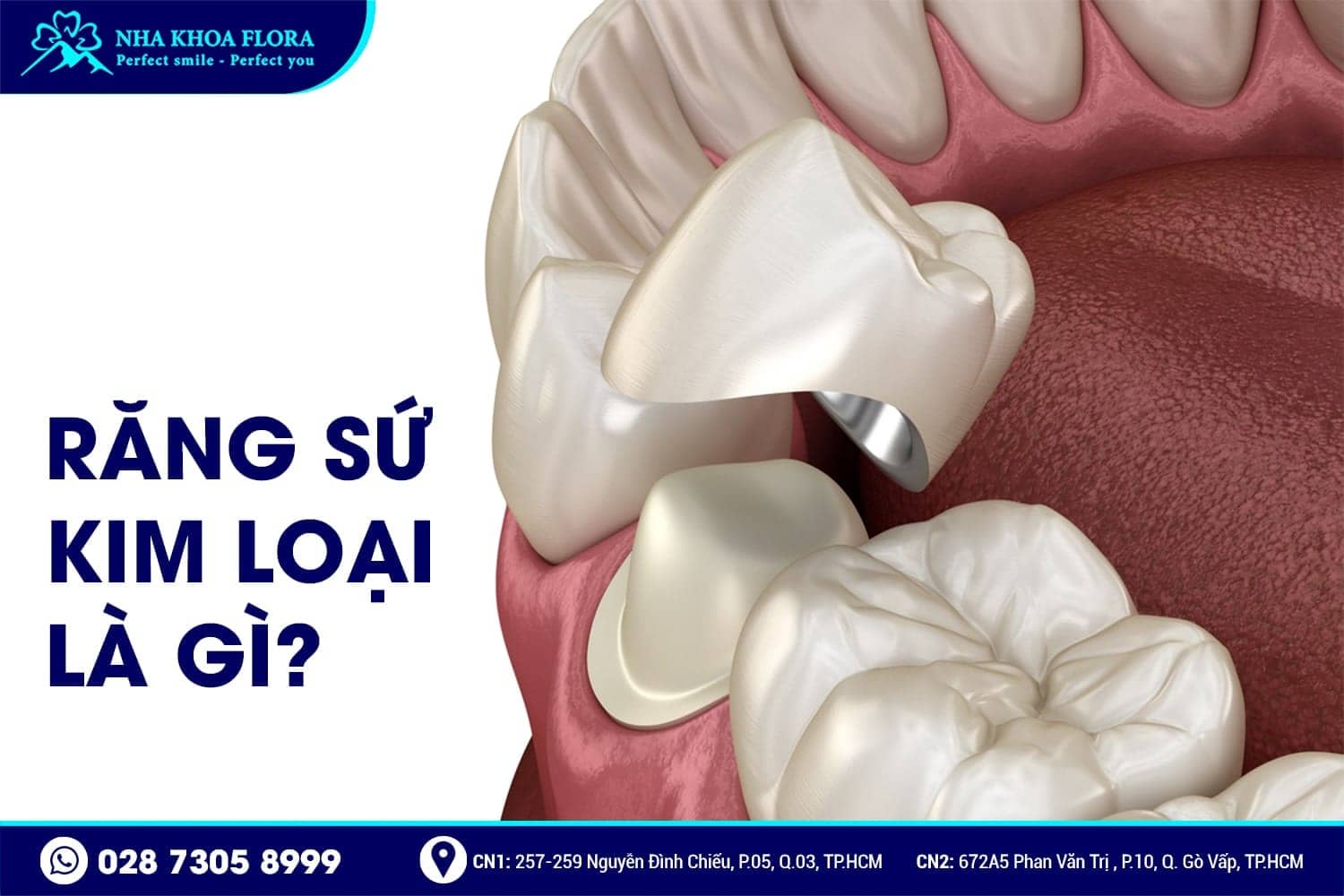 Răng Sứ Kim Loại Là Gì? Có Mấy Loại? Giá Bao Nhiêu? - ảnh 1 Răng Sứ Kim Loại Là Gì? Có Mấy Loại? Giá Bao Nhiêu? - ảnh 1