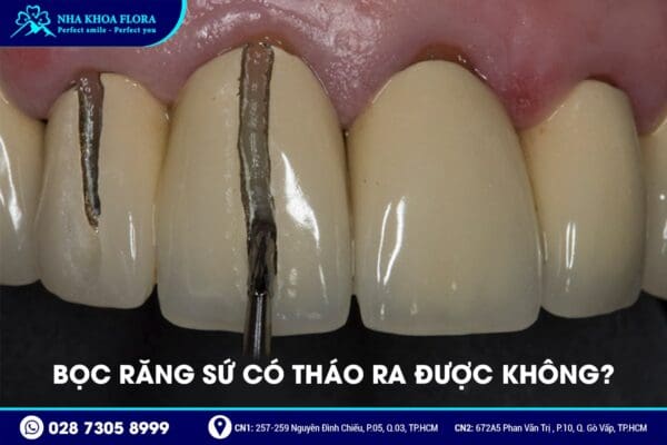 Bọc răng sứ có tháo ra được không? - ảnh 1 Bọc răng sứ có tháo ra được không? - ảnh 1