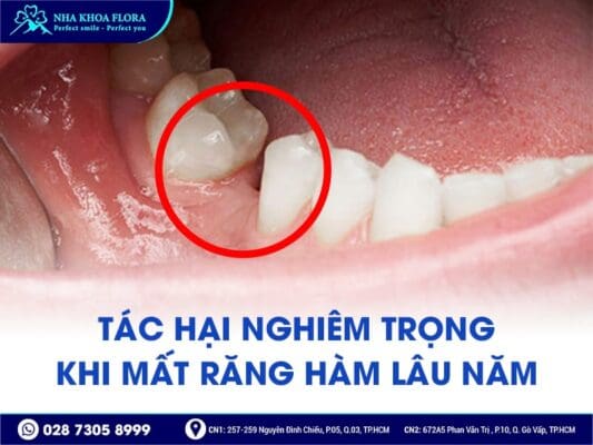 mất răng hàm lâu năm - ảnh 2 mất răng hàm lâu năm - ảnh 2