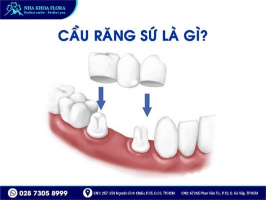 Mất răng nhai nên trồng răng Implant hay bắc cầu răng sứ? - ảnh 3 Mất răng nhai nên trồng răng Implant hay bắc cầu răng sứ? - ảnh 3