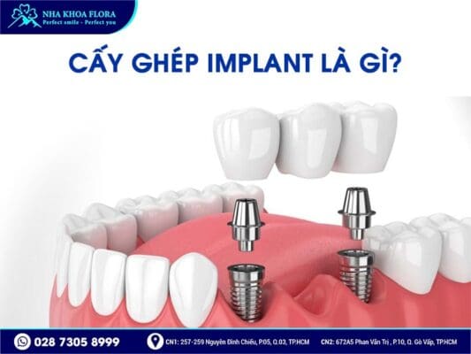 Mất răng nhai nên trồng răng Implant hay bắc cầu răng sứ? - ảnh 4 Mất răng nhai nên trồng răng Implant hay bắc cầu răng sứ? - ảnh 4