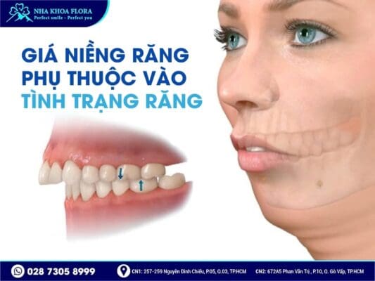 niềng răng bao nhiêu tiền - ảnh 3 niềng răng bao nhiêu tiền - ảnh 3