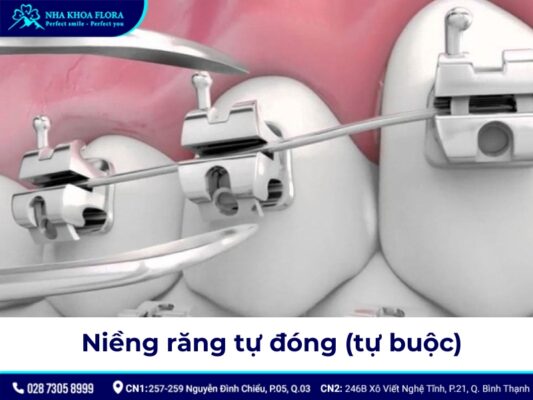 niềng răng có đau không - ảnh 4 niềng răng có đau không - ảnh 4