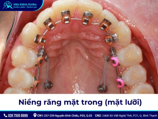 niềng răng có đau không - ảnh 5 niềng răng có đau không - ảnh 5