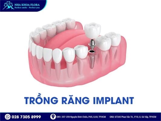 Phương pháp trồng răng giả nào tốt nhất hiện nay? - ảnh 3 Phương pháp trồng răng giả nào tốt nhất hiện nay? - ảnh 3