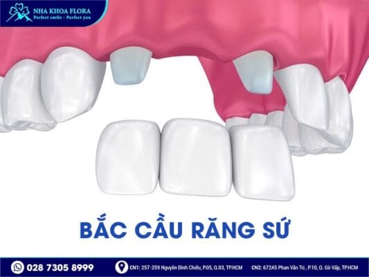 Phương pháp trồng răng giả nào tốt nhất hiện nay? - ảnh 4 Phương pháp trồng răng giả nào tốt nhất hiện nay? - ảnh 4