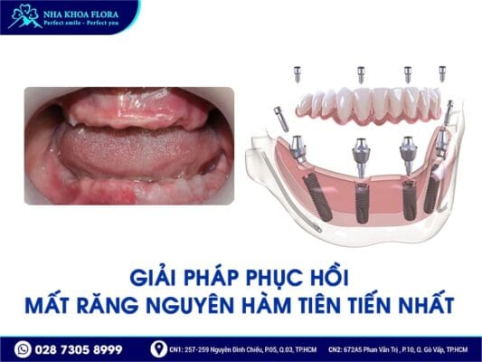 trồng răng nguyên hàm - ảnh 2 trồng răng nguyên hàm - ảnh 2