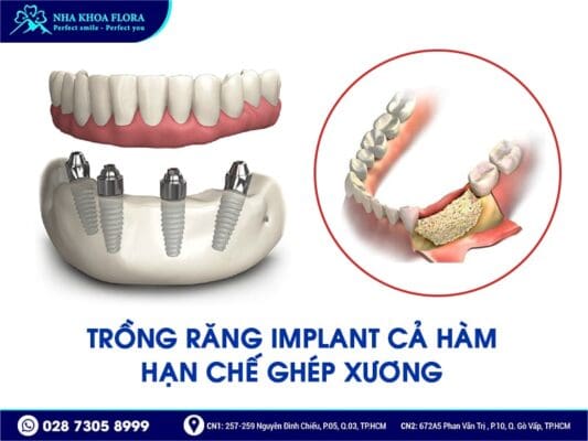 trồng răng nguyên hàm - ảnh 3 trồng răng nguyên hàm - ảnh 3