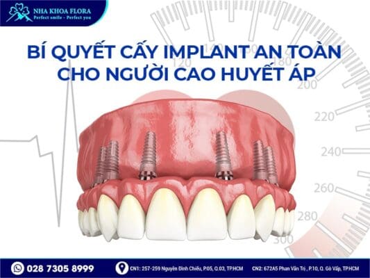 Cao huyết áp có cấy ghép Implant được không - ảnh 3 Cao huyết áp có cấy ghép Implant được không - ảnh 3