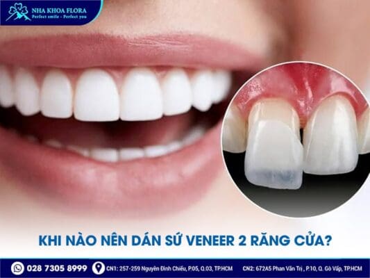 dán sứ Veneer 2 răng cửa - ảnh 1 dán sứ Veneer 2 răng cửa - ảnh 1