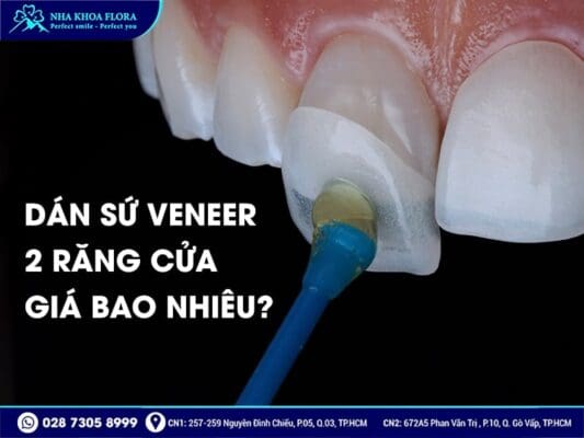 dán sứ Veneer 2 răng cửa - ảnh 3 dán sứ Veneer 2 răng cửa - ảnh 3