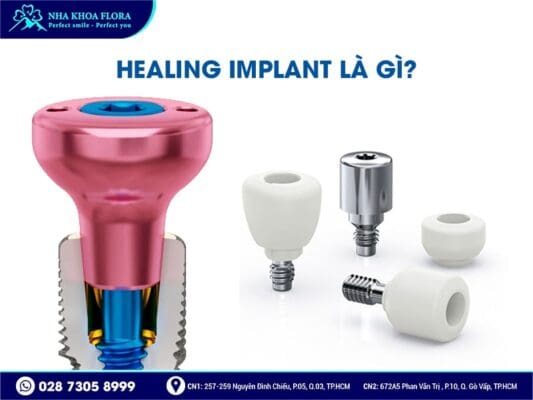 Healing Implant - ảnh 1 Healing Implant - ảnh 1
