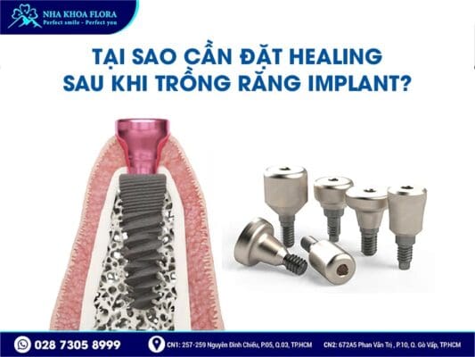 Healing Implant - ảnh 4 Healing Implant - ảnh 4