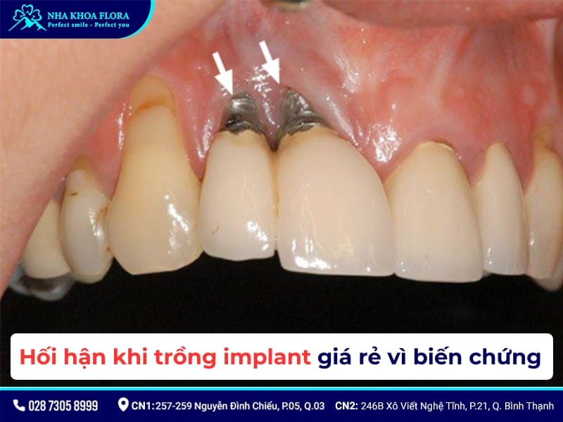 hối hận khi trồng implnat giá rẻ