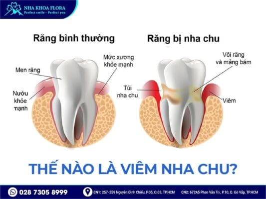 Viêm nha chu có cấy ghép implant được không - ảnh 1 Viêm nha chu có cấy ghép implant được không - ảnh 1