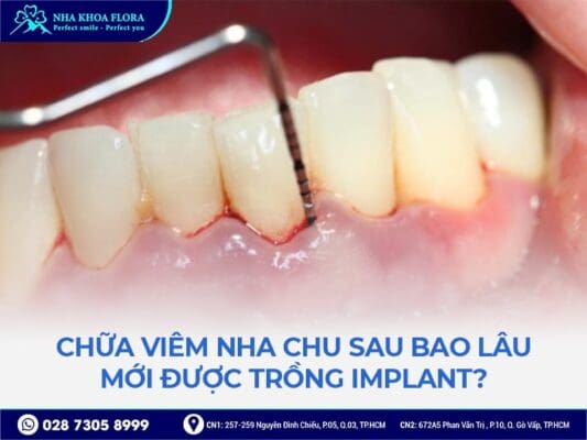 Viêm nha chu có cấy ghép implant được không - ảnh 3 Viêm nha chu có cấy ghép implant được không - ảnh 3