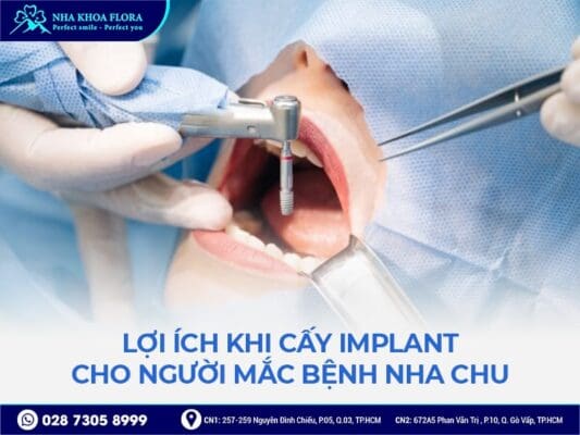 Viêm nha chu có cấy ghép implant được không - ảnh 4 Viêm nha chu có cấy ghép implant được không - ảnh 4