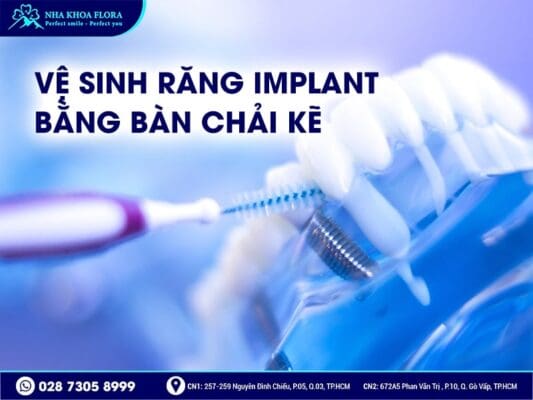 Cách vệ sinh răng Implant - ảnh 2 Cách vệ sinh răng Implant - ảnh 2