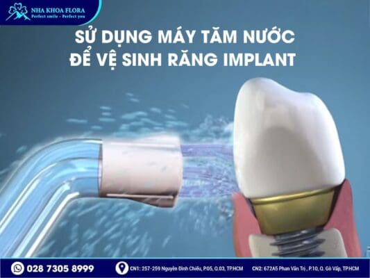 Cách vệ sinh răng Implant - ảnh 3 Cách vệ sinh răng Implant - ảnh 3