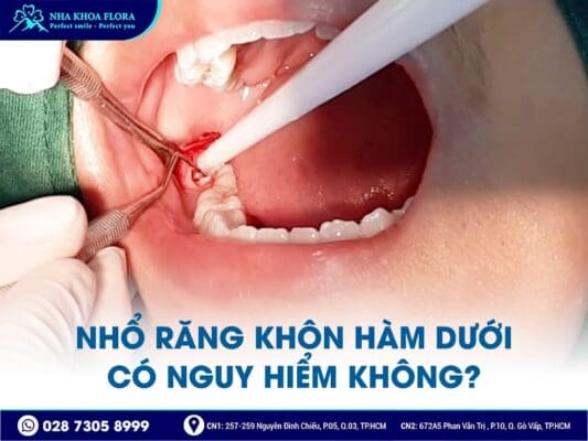 nhổ răng khôn có nguy hiểm không - ảnh 3 nhổ răng khôn có nguy hiểm không - ảnh 3