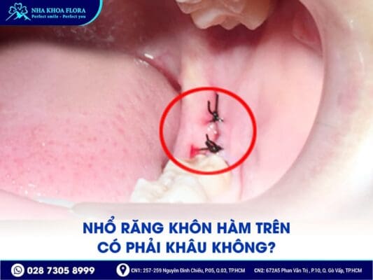 nhổ răng khôn hàm trên - ảnh 3 nhổ răng khôn hàm trên - ảnh 3