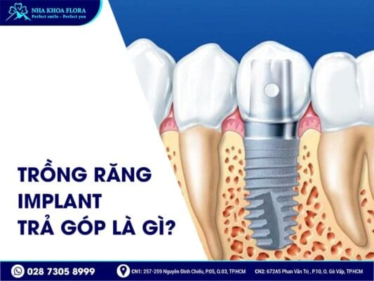 Trồng răng Implant trả góp - ảnh 1 Trồng răng Implant trả góp - ảnh 1