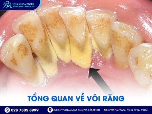 Cạo vôi răng có làm trắng răng không - ảnh 1 Cạo vôi răng có làm trắng răng không - ảnh 1