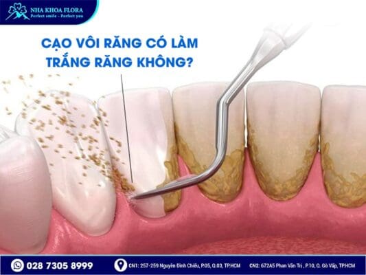 Cạo vôi răng có làm trắng răng không - ảnh 2 Cạo vôi răng có làm trắng răng không - ảnh 2