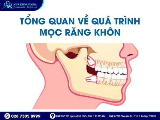 Dấu hiệu mọc răng khôn - ảnh 1 Dấu hiệu mọc răng khôn - ảnh 1
