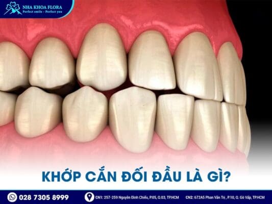 khớp cắn đối đầu - ảnh 1 khớp cắn đối đầu - ảnh 1