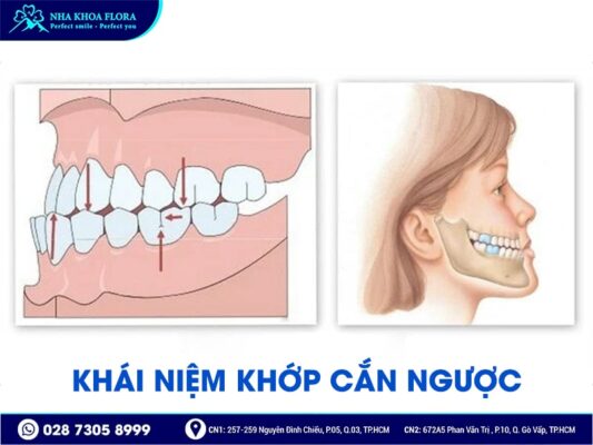 khớp cắn ngược - ảnh 1 khớp cắn ngược - ảnh 1