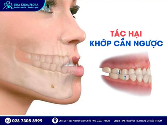 khớp cắn ngược - ảnh 3 khớp cắn ngược - ảnh 3