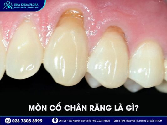 Mòn cổ chân răng - ảnh 1 Mòn cổ chân răng - ảnh 1