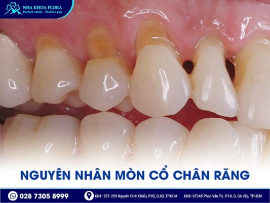 Mòn cổ chân răng - ảnh 2 Mòn cổ chân răng - ảnh 2