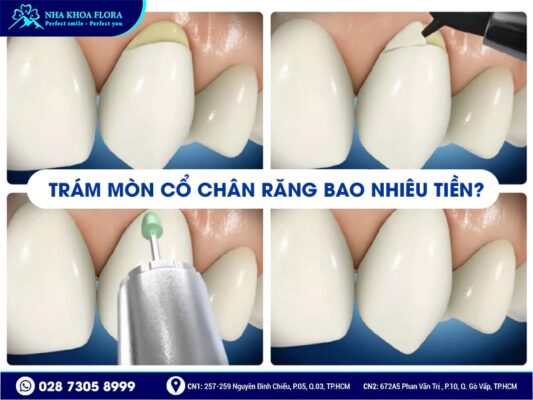 Mòn cổ chân răng - ảnh 4 Mòn cổ chân răng - ảnh 4