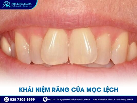 răng cửa mọc lệch - ảnh 1 răng cửa mọc lệch - ảnh 1