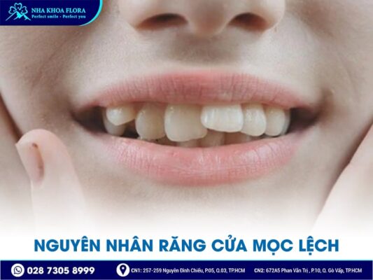 răng cửa mọc lệch - ảnh 2 răng cửa mọc lệch - ảnh 2