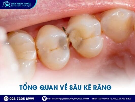 sâu kẽ răng - ảnh 1 sâu kẽ răng - ảnh 1